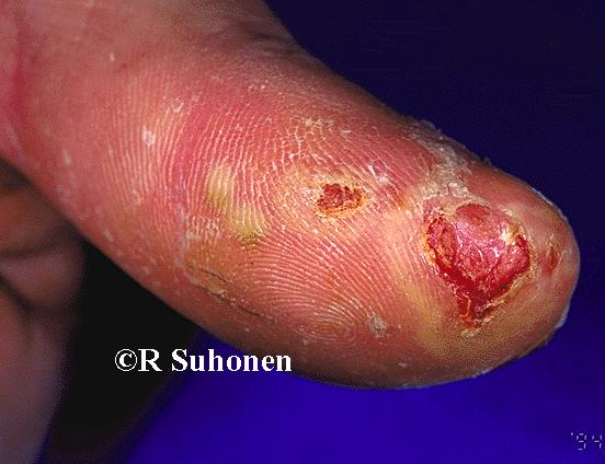 Acrodermatitis continua (Hallopeau) in the skin of the thumb