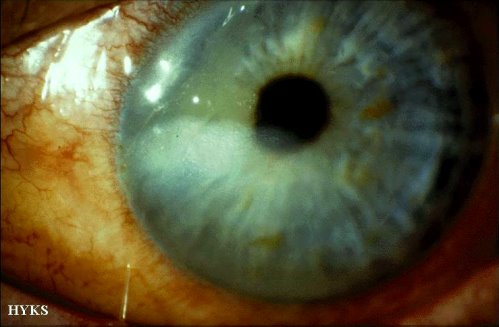 Alkali burn of the cornea