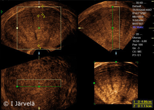 Adenomyosis (ultrasound scan)