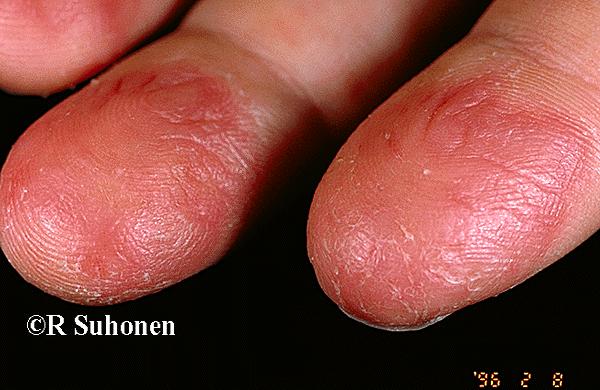 "Snowball fingers" - a manifestation of atopic dermatitis