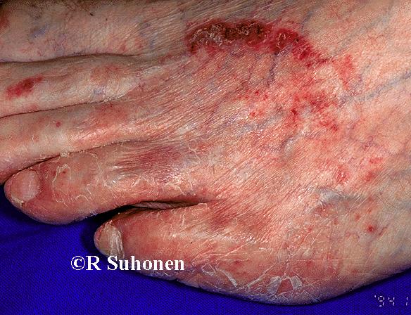 A fungal infection caused by T. rubrum on the dorsal surface of the foot