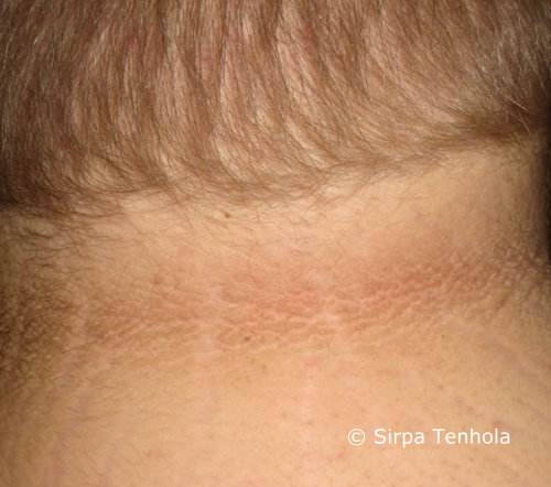 Acanthosis nigricans on the back of the neck