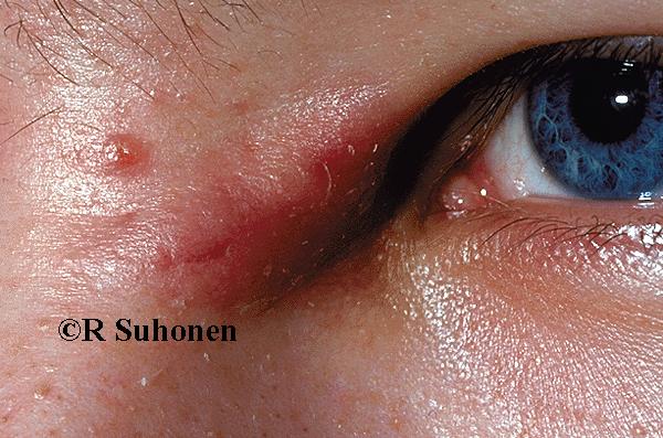 An acne cyst at the base of the nose