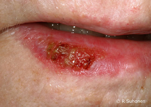 Actinic keratosis on the lip