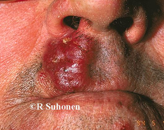 A T-cell lymphoma on the upper lip