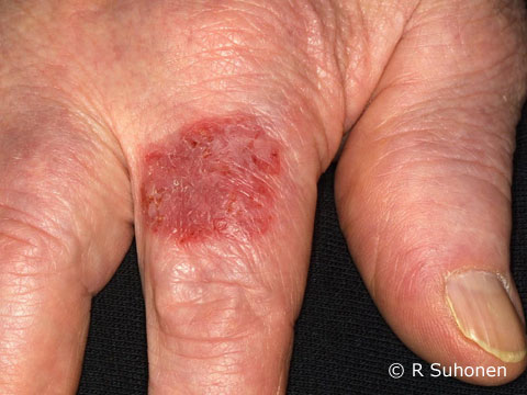 Actinic keratosis in a finger