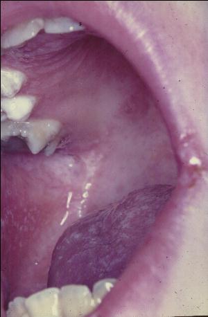 APECED: Oral candidiasis and leukoplakia