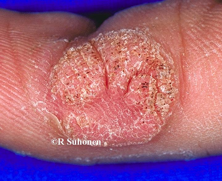 A large viral wart on the side of a finger