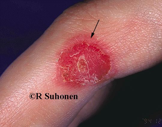 A small area of pyoderma in the side of a finger