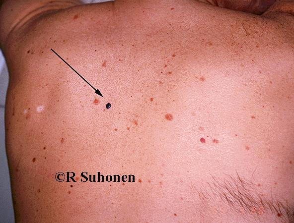 A small nodular malignant melanoma on the back