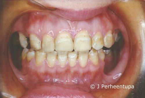  APECED: Dental enamel hypoplasia