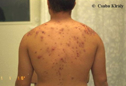 Acne in a steroid abuser