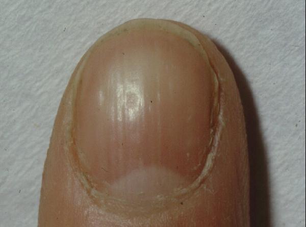 APECED: Pitted nail dystrophy