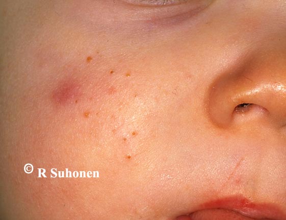 Acne in an infant