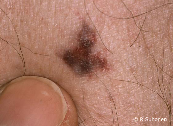 Angiokeratoma resembling a melanoma