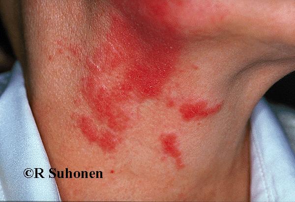 Allergic dermatitis on the neck, caused by Primula obconica