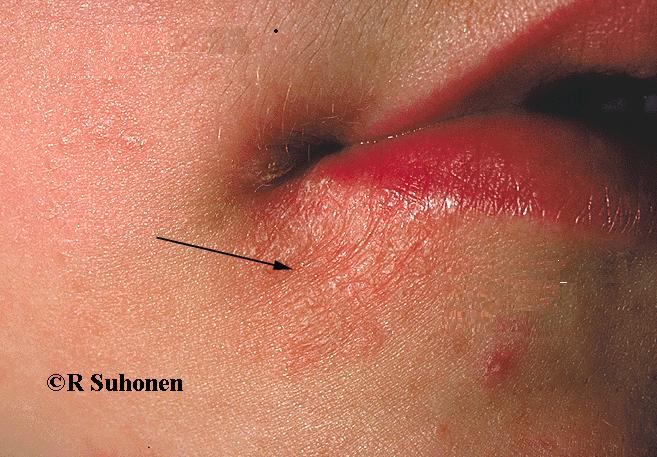 Angular cheilitis (atopic dermatitis) at the corner of the mouth in a child