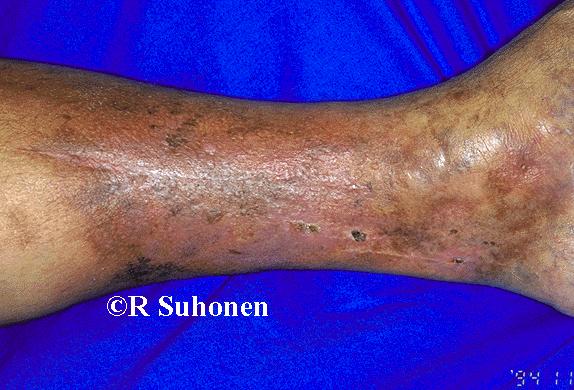 A long-term venous problem of the leg