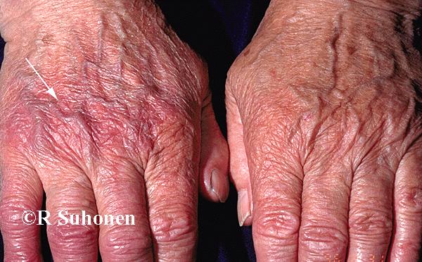 Acrodermatitis chronica atrophicans on the dorsal aspect of the hands