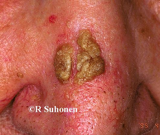 Actinic keratosis on the nose