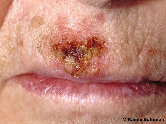 Actinic keratosis in the upper lip